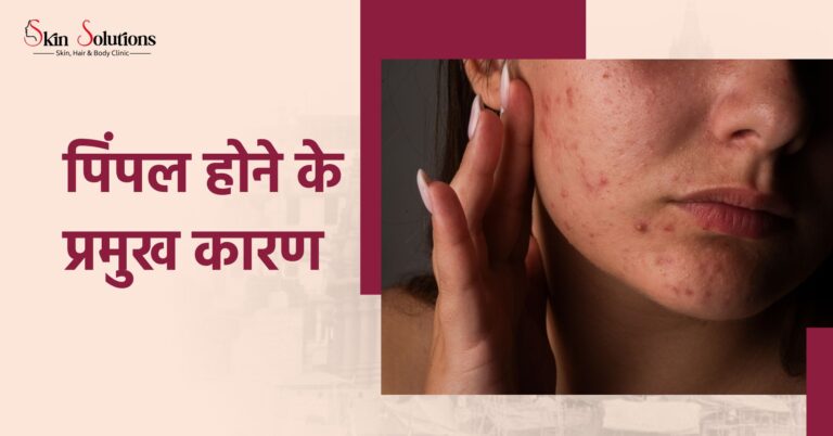 वाराणसी में पिंपल का इलाज
