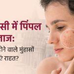 वाराणसी में पिंपल का इलाज